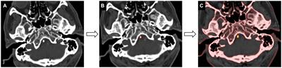 CT texture analysis of vertebrobasilar artery calcification to identify culprit plaques